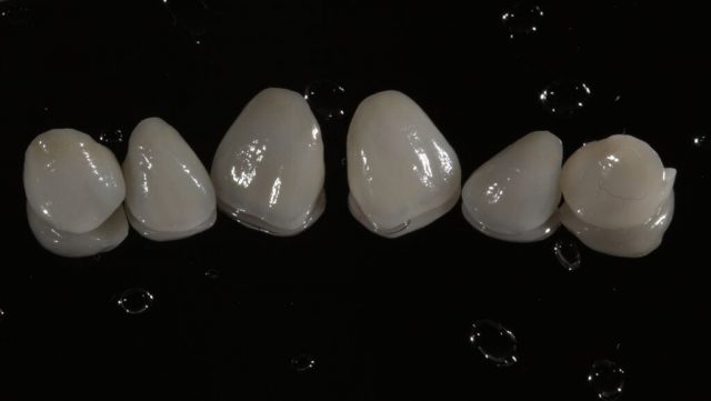 Fațetele dentare